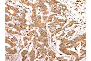 The image on the left is immunohistochemistry of paraffin-embedded Human colon cancer tissue using ABIN7190209(CELSR2 Antibody) at dilution 1/50, on the right is treated with synthetic peptide. (CELSR2 antibody)
