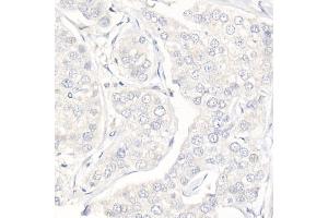Immunohistochemistry of paraffin-embedded Human triple negative breast cancer (negative control sample) using Progesterone Receptor Rabbit mAb (ABIN7269533) at dilution of 1:100 (40x lens). (Progesterone Receptor antibody)