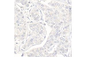 Immunohistochemistry of paraffin-embedded Human triple negative breast cancer (negative control sample) using Progesterone Receptor Rabbit mAb (ABIN7269533) at dilution of 1:100 (40x lens).