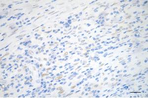 Immunohistochemistry was performed on paraffin-embedded human sigmoid colon carcinoma using PCYT1A antibody (ABIN7799789), 1:200). (Recombinant PCYT1A antibody)