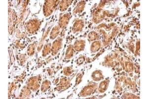 IHC-P Image BCL2L12 antibody detects BCL2L12 protein at cytosol and nucleus on human colon carcinoma by immunohistochemical analysis. (BCL2L12 antibody  (C-Term))