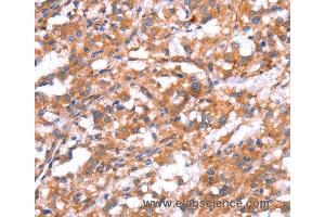Immunohistochemistry of Human thyroid cancer using GABBR1 Polyclonal Antibody at dilution of 1:30