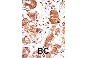Formalin-fixed and paraffin-embedded human cancer tissue reacted with the PIM1 polyclonal antibody  , which was peroxidase-conjugated to the secondary antibody, followed by DAB staining.