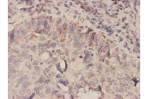 Immunoperoxidase of monoclonal antibody to MIF on formalin-fixed paraffin-embedded human lung, adenosquamous cell carcinoma tissue. (MIF antibody  (AA 1-115))