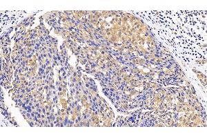 Detection of MAPK14 in Human Breast cancer Tissue using Polyclonal Antibody to Mitogen Activated Protein Kinase 14 (MAPK14)