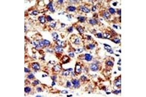Formalin-fixed and paraffin-embedded human cancer tissue reacted with the primary antibody, which was peroxidase-conjugated to the secondary antibody, followed by AEC staining. (HDAC8 antibody  (N-Term))