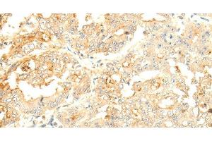 Immunohistochemistry of paraffin-embedded Human gastric cancer tissue using SOCS6 Polyclonal Antibody at dilution 1:50 (SOCS6 antibody)