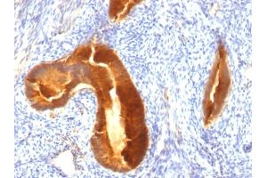 Formalin-fixed, paraffin-embedded human Endometrial Carcinoma stained with MUC-1 / CA15-3 / EMA Mouse Monoclonal Antibody (MUC1/955). (MUC1 antibody)