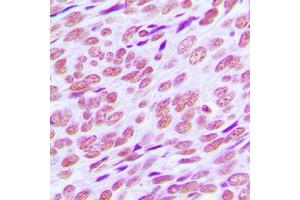 Immunohistochemical analysis of Cyclin E1 staining in human breast cancer formalin fixed paraffin embedded tissue section. (Cyclin E1 antibody  (C-Term))