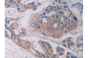 Detection of PTK7 in Human Breast cancer Tissue using Polyclonal Antibody to Tyrosine Protein Kinase 7 (PTK7) (Tyrosine Protein Kinase 7 (AA 853-1070) antibody)