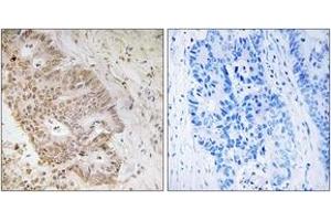 Immunohistochemistry analysis of paraffin-embedded human colon carcinoma tissue, using ZNF592 Antibody.
