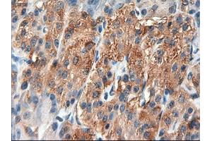 Immunohistochemical staining of paraffin-embedded Carcinoma of liver using anti-PTCH1 (ABIN2452537) mouse monoclonal antibody. (Patched 1 antibody  (AA 122-436))