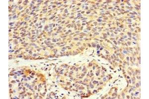 Immunohistochemistry of paraffin-embedded human ovarian cancer using ABIN7175332 at dilution of 1:100 (VTA1 antibody  (AA 23-307))