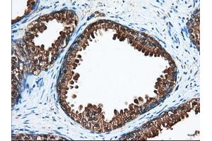 Immunohistochemical staining of paraffin-embedded Adenocarcinoma of Human ovary tissue using anti-ACAT2 mouse monoclonal antibody. (ACAT2 antibody)