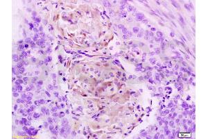 Formalin-fixed and paraffin embedded human esophageal carcinoma tissue labeled with Anti-Cathepsin B Polyclonal Antibody, Unconjugated (ABIN687412) at 1:200 followed by conjugation to the secondary antibody, (SP-0023), and DAB staining (Cathepsin B antibody  (AA 251-339))