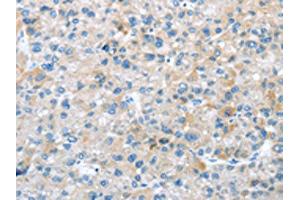 The image on the left is immunohistochemistry of paraffin-embedded Human liver cancer tissue using ABIN7192908(TRIM47 Antibody) at dilution 1/20, on the right is treated with synthetic peptide. (TRIM47 antibody)