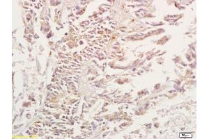 Formalin-fixed and paraffin embedded human gastric carcinoma tissue labeled with Anti-ADORA3/Adenosine A3 Receptor Polyclonal Antibody, Unconjugated (ABIN673629) at 1:200, followed by conjugation to the secondary antibody and DAB staining (Adenosine A3 Receptor antibody  (AA 85-180))
