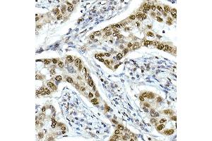 Immunohistochemistry of paraffin-embedded human lung cancer using T Rabbit mAb (ABIN7270715) at dilution of 1:25 (40x lens).