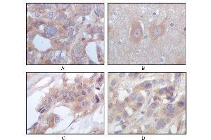 Immunohistochemical analysis of paraffin-embedded human ovary carcinoma (A), normal cerebrum tissues (B), breast infiltrating carcinoma (C) and breast infiltrating carcinoma (D), showing cytoplasmic localization using STYK1/NOK mouse mAb with DAB staining. (STYK1 antibody)