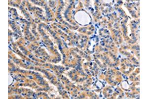 The image on the left is immunohistochemistry of paraffin-embedded Human thyroid cancer tissue using ABIN7128359(ALG8 Antibody) at dilution 1/30, on the right is treated with fusion protein. (ALG8 antibody)