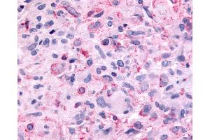 Anti-MTNR1B / MT2 antibody IHC of human Brain, Glioblastoma. (Melatonin Receptor 1B antibody  (Extracellular Domain))