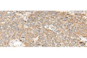 Immunohistochemistry of paraffin-embedded Human liver cancer tissue using C1orf101 Polyclonal Antibody at dilution of 1:65(x200)