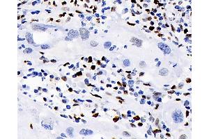 Immunohistochemistry analysis of paraffin-embedded human lymphoma using ERK 2 Polyclonal Antibody at dilution of 1:100. (ERK2 antibody)