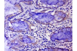 Paraformaldehyde-fixed, paraffin embedded human colon carcinoma tissue, Antigen retrieval by boiling in sodium citrate buffer(pH6) for 15min, Block endogenous peroxidase by 3% hydrogen peroxide for 30 minutes, Blocking buffer (normal goat serum) at 37°C for 20min, Antibody incubation with Rabbit Anti-CWG43 Polyclonal Antibody, Unconjugated  at 1:400 overnight at 4°C, followed by a conjugated secondary and DAB staining (CWH43 antibody  (AA 540-590))