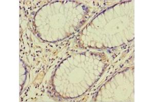 Immunohistochemistry of paraffin-embedded human colon cancer using ABIN7172672 at dilution of 1:100 (TAF12 antibody  (AA 1-161))