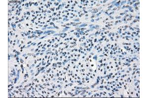 Immunohistochemical staining of paraffin-embedded Adenocarcinoma of colon tissue using anti-FOSL1mouse monoclonal antibody. (FOSL1 antibody)