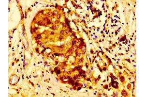 Immunohistochemistry of paraffin-embedded human breast cancer using ABIN7147000 at dilution of 1:100 (Cathepsin D antibody  (AA 67-403))