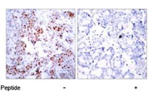 Immunohistochemical analysis of paraffin-embedded human breast carcinoma tissue using ATF2 polyclonal antibody . (ATF2 antibody)
