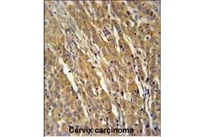 PDXD1 Antibody (C-term) (ABIN651141 and ABIN2840095) immunohistochemistry analysis in formalin fixed and paraffin embedded human cervix carcinoma followed by peroxidase conjugation of the secondary antibody and DAB staining. (PDXDC1 antibody  (C-Term))