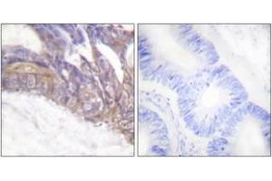 Immunohistochemistry analysis of paraffin-embedded human colon carcinoma, using LAT (Phospho-Tyr191) Antibody. (LAT antibody  (pTyr191))