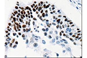 The image on the left is immunohistochemistry of paraffin-embedded Human cervical cancer tissue using ABIN7131338(TGIF2LX Antibody) at dilution 1/25, on the right is treated with fusion protein. (TGIF2LX antibody)