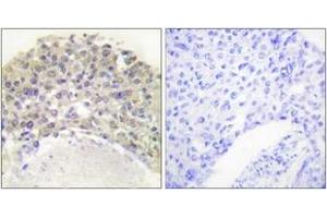 Immunohistochemistry analysis of paraffin-embedded human breast carcinoma, using Shc (Phospho-Tyr349) Antibody.