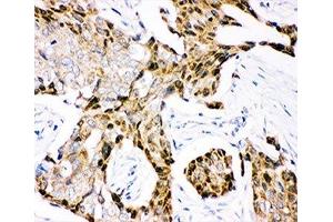 IHC-P: Ubiquitin antibody testing of human mammary cancer tissue (Ubiquitin antibody  (AA 77-152))