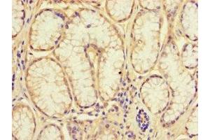Immunohistochemistry of paraffin-embedded human gastric cancer using ABIN7161926 at dilution of 1:100 (NRIP3 antibody  (AA 1-241))
