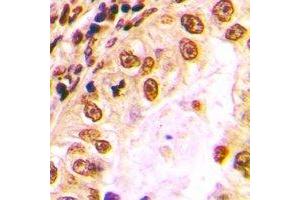 Immunohistochemical analysis of Nibrin staining in human lung cancer formalin fixed paraffin embedded tissue section. (Nibrin antibody)