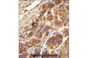 Formalin-fixed and paraffin-embedded human hepatocarcinoma with KLC1 Antibody (Center), which was peroxidase-conjugated to the secondary antibody, followed by DAB staining. (KLC1 antibody  (AA 389-415))