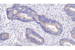 Detection of Bcl2 in Human Colorectal cancer Tissue using Monoclonal Antibody to B-Cell Leukemia/Lymphoma 2 (Bcl2) (Bcl-2 antibody  (AA 2-211))