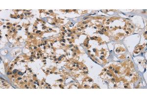 Immunohistochemistry of paraffin-embedded Human thyroid cancer tissue using IL12RB2 Polyclonal Antibody at dilution 1:40 (IL12RB2 antibody)