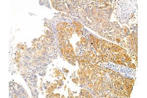 ABIN6260480 and ABIN6266502 at 1/100 staining Human liver cancer by IHC-P. (Caspase 10 antibody  (C-Term))