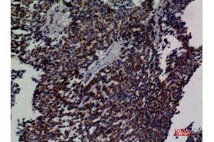 Immunohistochemistry (IHC) analysis of paraffin-embedded Human Lung Cancer, antibody was diluted at 1:100. (DCI antibody  (C-Term))