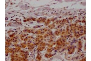 IHC image of ABIN7127610 diluted at 1:100 and staining in paraffin-embedded human breast cancer performed on a Leica BondTM system. (Recombinant MAPKAP Kinase 2 antibody)
