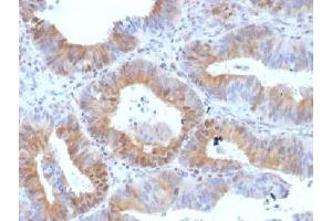 IHC testing of FFPE human ovarian carcinoma with LHR antibody (clone LHCGR/1417). (LHCGR antibody  (N-Term))