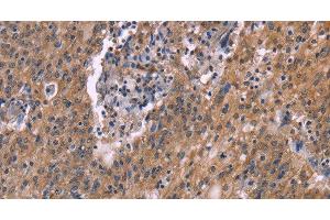 Immunohistochemistry of paraffin-embedded Human liver cancer tissue using HSD11B2 Polyclonal Antibody at dilution 1:35 (HSD11B2 antibody)