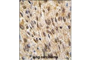 Formalin-fixed and paraffin-embedded human lung carcinoma tissue reacted with PTPN6 antibody (Center), which was peroxidase-conjugated to the secondary antibody, followed by DAB staining. (SHP1 antibody  (AA 247-277))