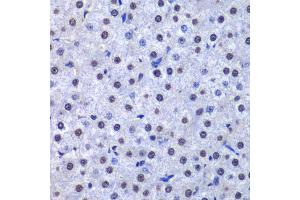 Immunohistochemistry of paraffin-embedded human liver cancer using GSTP1 antibody (ABIN5973328) at dilution of 1/200 (40x lens). (GSTP1 antibody)