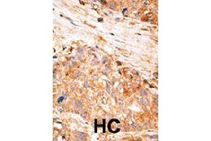 Formalin-fixed and paraffin-embedded human hepatocellular carcinoma tissue reacted with BIRC7 polyclonal antibody  , which was peroxidase-conjugated to the secondary antibody, followed by AEC staining.